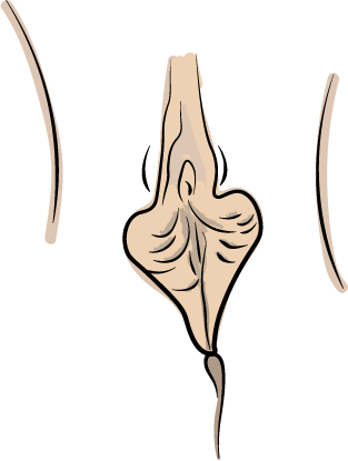 labioplastia