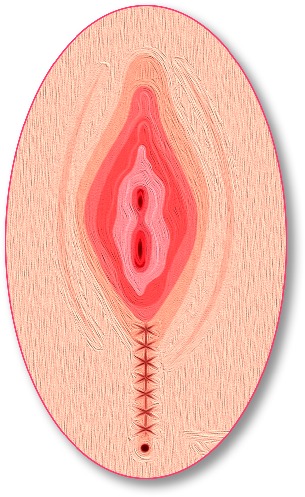 perinoplastia