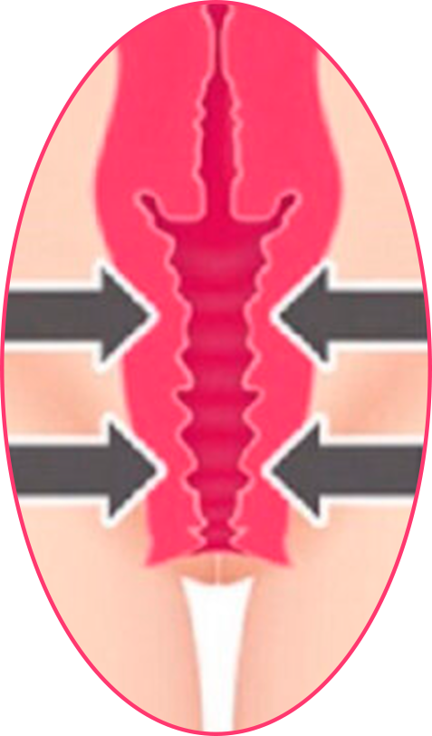 tensado vaginal